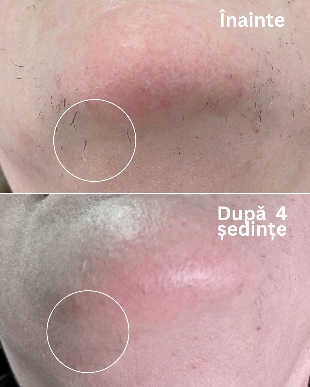 Epilare-definitiva-laser-alexandrite-oradea-fata