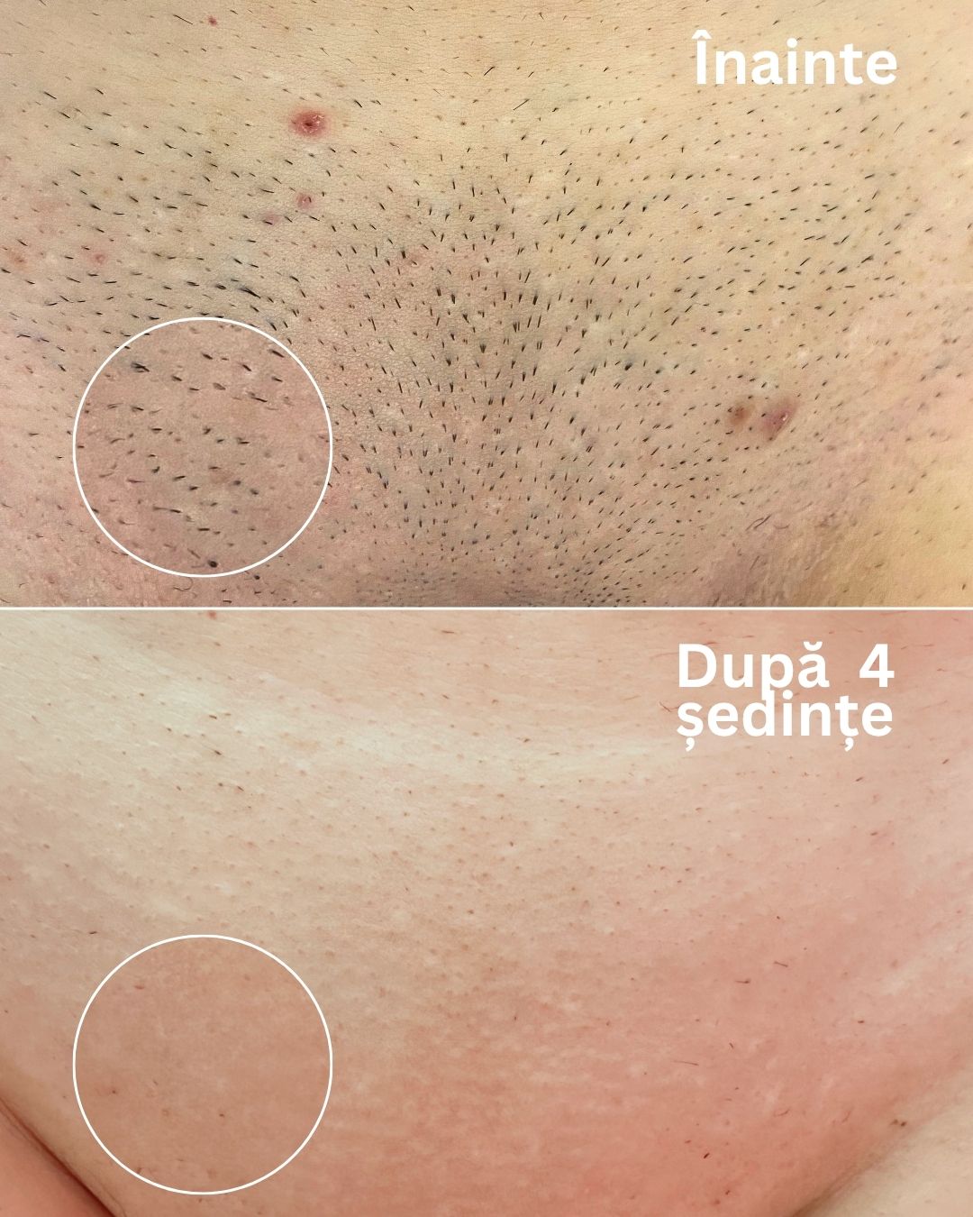 epilare-definitiva-laser-oradea