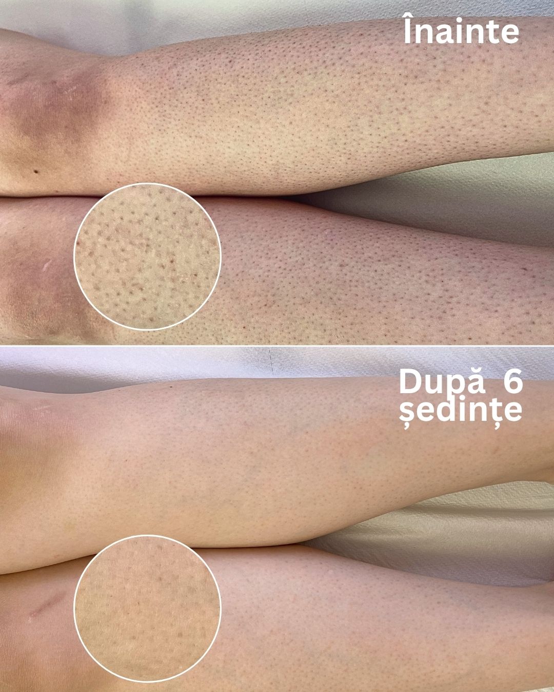 epilare-laser-alexandrite-oradea