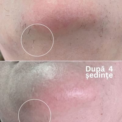 Epilare-definitiva-laser-alexandrite-oradea-fata
