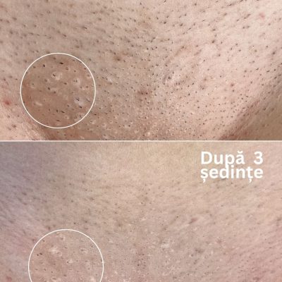 before-and-after-epilare-laser-alexandrite